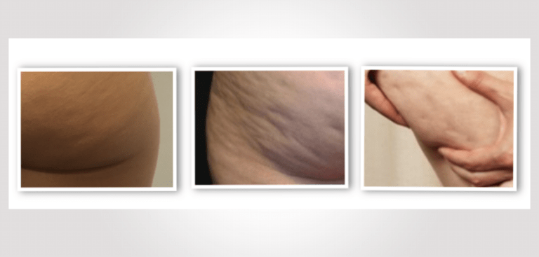 Scopri di più sull'articolo Cellulite e Allenamento: Strategie Efficaci per Contrastare l’Inestetismo